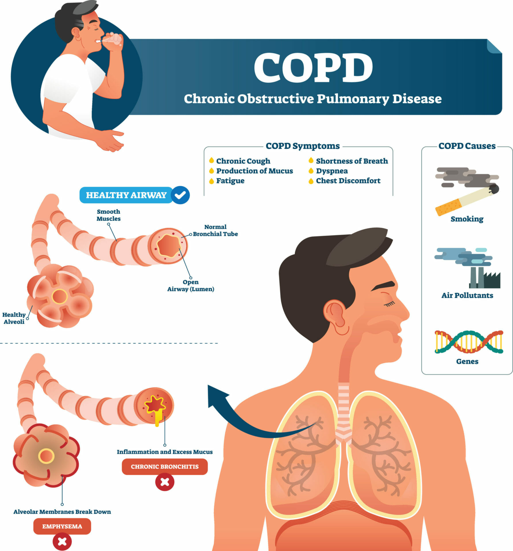 copd